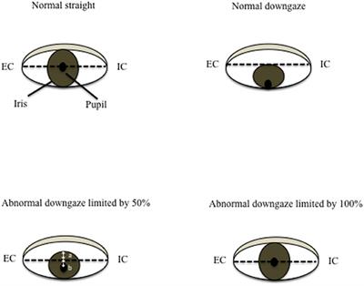 Severity of Downgaze Palsy in the Context of Disease Duration Could Estimate Survival Duration in Patients With Progressive Supranuclear Palsy